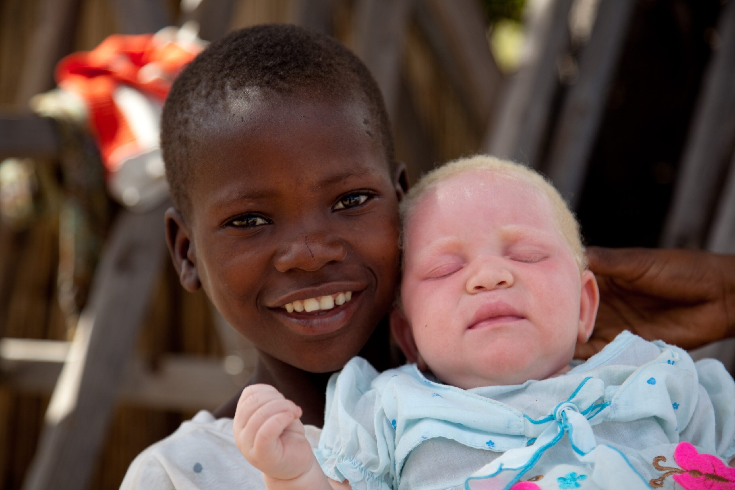 Wie der Albino-Mythos Kinder in Tansania in Gefahr bringt